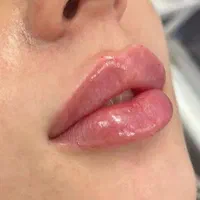 تزریق ژل بوتاکس لیزر هایفو مزو پی ار پی نخ فیشیال|خدمات آرایشگری و زیبایی|شهریار, |دیوار