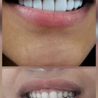 دندانپزشکی/ کامپوزیت زیبایی/ لمینت/دندان مصنوعی|خدمات آرایشگری و زیبایی|تهران, نعمت‌آباد|دیوار