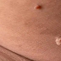 برداشتن خال زگیل گوشت اضاف برداشت زگیل تناسلی|خدمات آرایشگری و زیبایی|شیراز, معالی‌آباد|دیوار