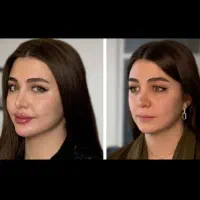 بوتاکس و ژل فقط ۸۰۰تومن