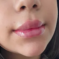 تزریق ژل و بوتاکس با تخفیف ویژه بهاری*|خدمات آرایشگری و زیبایی|جوانرود, |دیوار