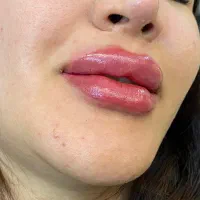 ژل بوتاکس لیزر فول بادی فقط ۳۸۰ جوابدهی تضمینی