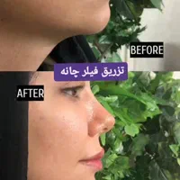 تزریق ژل و بوتاکس توسط پزشک|خدمات آرایشگری و زیبایی|بروجرد, |دیوار