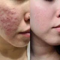 جشنواره فیلر بوتاکس و میکرونیدلینگ تخصصی پوست