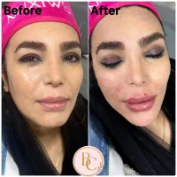 تزریق فیلر لب بادی بوتاکس فول فیس بلفارو غبغب|خدمات آرایشگری و زیبایی|تهران, نیاوران|دیوار