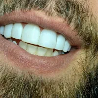 کامپوزیت دندان|خدمات آرایشگری و زیبایی|اهواز, ۲۴ متری|دیوار