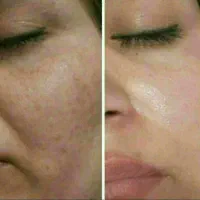 از بین رفتن لکه های صورت