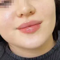 تزریق تخصصی فیلر صورت و لب رایگان جهت مدل|خدمات آرایشگری و زیبایی|تهران, ونک|دیوار