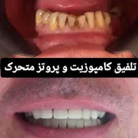 دندان مصنوعی تحویل ۵ساعته(شهر محلات)کامپوزیت دندان|خدمات آرایشگری و زیبایی|قم, سالاریه|دیوار