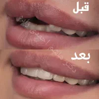 ایمپلنت دندان کاشت و روکش فوری اوردنچر از دم اقساط|خدمات آرایشگری و زیبایی|تهران, قیطریه|دیوار