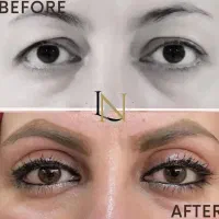 جشنواره تخفیفات ویژه عمل‌های پلک،ابرو،بوتاکس