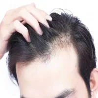 جلوگیری از ریزش مو و رویش مو آلوپسی سکه ای