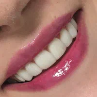 (زیبایی) ونییر کامپوزیت و لمینیت، بلیچینگ