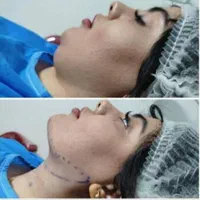ساکشن غبغب با پال دیجیتالی و اندولیفت پوست اضافه|خدمات آرایشگری و زیبایی|مشهد, سناباد|دیوار
