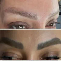 لیزر پاک کردن تاتو