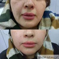 انجام تمامی خدمات فیلر و بوتاکس|خدمات آرایشگری و زیبایی|سبزوار, توحیدشهر|دیوار