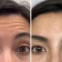 تزریق بوتاکس صورت