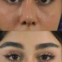 مرکز بلفاروپلاستی لیزری دیجیتالی مشهد/شقیقه/غبغب