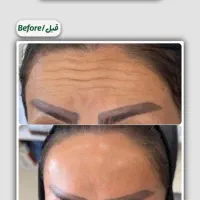 اف ویژه بوتاکس تعداد محدود|خدمات آرایشگری و زیبایی|یاسوج, |دیوار