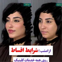 بوتاکس پیشانی و خط اخم رایگان شد روز یکشنبه