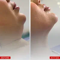 ساکشن غبغب فقط۷ میلیون