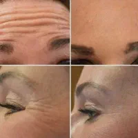 خدمات جوانسازی با بوتاکس|خدمات آرایشگری و زیبایی|چمستان, |دیوار