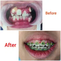 ارتودنسی لبخندی زیبا(فقط تا آخر ماه)|خدمات آرایشگری و زیبایی|مشهد, آزادشهر|دیوار