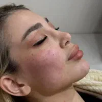 جشنواره تخفیف بوتاکس فیلر.فیلربادی مزو تزریق چربی