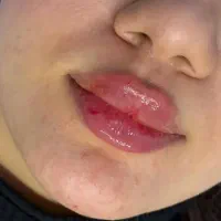 تزریق صورت با تکنیک m