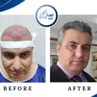 کاشت مو پرتراکم