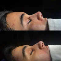 رینوپلاستی فقط ۳۷تومن