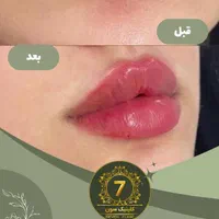 تخفیفات ۴۰ درصدی دکتر کاظمی ژل و بوتاکس فیلر مزو|خدمات آرایشگری و زیبایی|مشهد, کوثر|دیوار