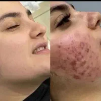 جشنوار یلدا درمان تضمینی کک ومک/لک/خال/فقط در1جلسه|خدمات آرایشگری و زیبایی|اصفهان, باغ زیار|دیوار