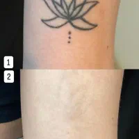 ریموتتو ابرو و بدن با پیشرفته ترین دستگاه تضمینی