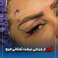لیفت تحتانی ابرو، بلفاروپلاستی، لیفت صورت و ابرو