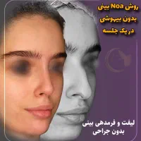 آف رینوپلاستی بینی بدون عمل جراحی NOA پزشک زیبایی|خدمات آرایشگری و زیبایی|مشهد, هفت تیر (آب و برق)|دیوار