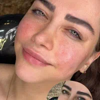 مدل تزریق فیلر کاملا زیر نظر استاد