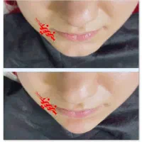 تزریق فیلر ژل و بوتاکس در کلینیک|خدمات آرایشگری و زیبایی|بندرعباس, |دیوار