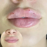 ژل،بوتاکس،مزوتراپی مو صورت،آنزیم،فیلرلب|خدمات آرایشگری و زیبایی|کرج, ساماندهی|دیوار