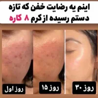 بهبود انواع لک های صورت ،بارداری و ملاسما