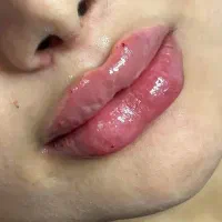 جشنواره ویژه فیلر لب فول فیس زاویه فک،گونه،چونه و.|خدمات آرایشگری و زیبایی|مشهد, شهید فرامرز عباسی|دیوار