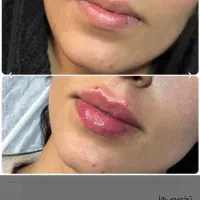 جشنواره تخفیف ویژه تزریق ژل و بوتاکس|خدمات آرایشگری و زیبایی|اصفهان, بوستان آینه خانه|دیوار