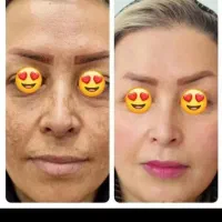 روشن کننده صورت و دست معجزه بشرط اصلی و گیاهی