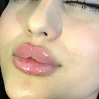 کلینیک تخصصی فیلرژل بوتاکس واموزش باتخفیف۵۰درصدی