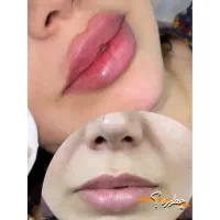 فیلر‌‌ صورت /  ژل صورت|خدمات آرایشگری و زیبایی|فولادشهر, B2|دیوار