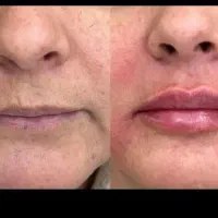 تزریق فیلر|خدمات آرایشگری و زیبایی|الشتر, |دیوار