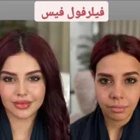 خدمات رایگان بوتاکس،ژل،فیلر توسط پزشک در ارومیه