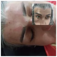 ژل و بوتاکس