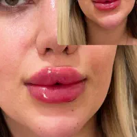 تزریق ژل و فیلر و بوتاکس