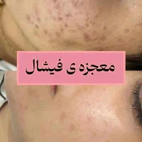 آموزش فیشیال پاکسازی پوست تخفیف بلک فرایدی